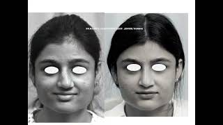 Tips for management of asymmetric crocked nose and caudal septal deviation