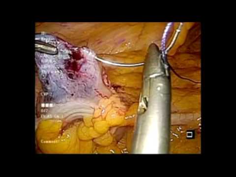 EndoscopicEndoscopicSubmucosa Dissection through Trans-Anal Minimally Invasive Surgery for rectal pr. 