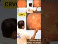 CRVO#fmge #neetpg #inicet2025 #neetpg2026 #marrow #cerebellum