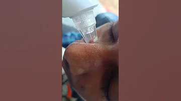 Whitehead's removing. #machine use 100% 😱nannyi pokunnud#youtube #whiteheads