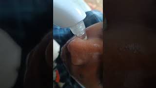 Whitehead's removing. #machine use 100% 😱nannyi pokunnud#youtube #whiteheads