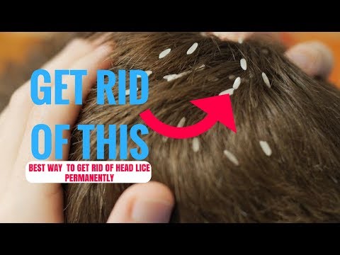 Best Way  to Get Rid of Head Lice Permanently And At Home For Children and Adults