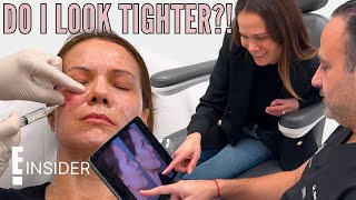BEFORE & AFTER: Celebrity Plastic Surgeon Breaks Down Impressive Microneedling Results | E! Tried It