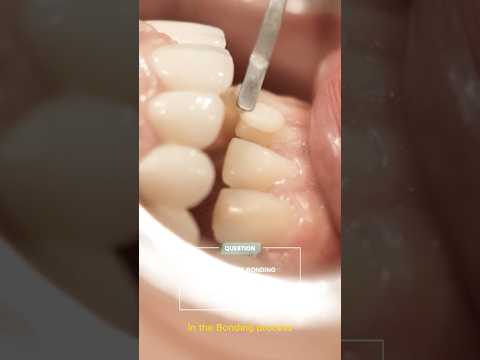 Bonding Prosedürü Nedir?