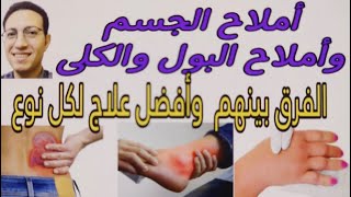 علاج الاملاح في الجسم/علاج الاملاح في الكلى والبول