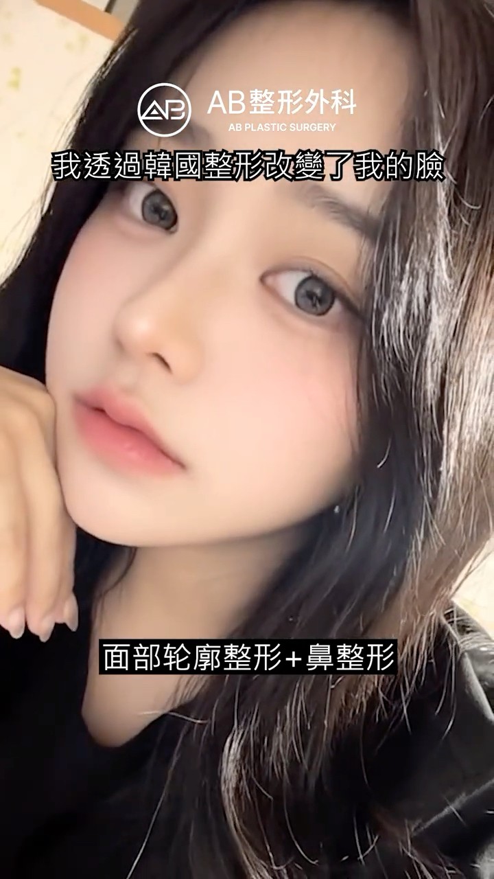 輪廓三件套＋隆鼻＋脂肪移植後變化有多大？ #Shorts