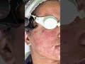 Still Struggling With Acne? Watch This | Treating Active Acne &amp; Scarring