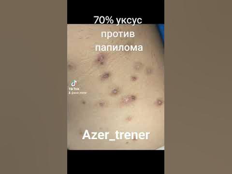 папилома на связи - YouTube