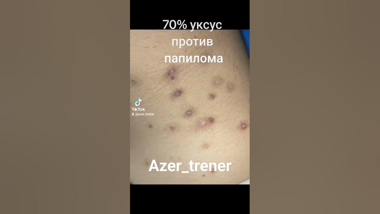 папилома на связи - YouTube
