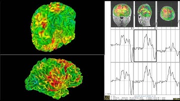 Sensorimotor Synchronization Brain Activation