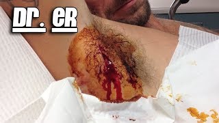 Armpit Abscess Core Removal, Part Two