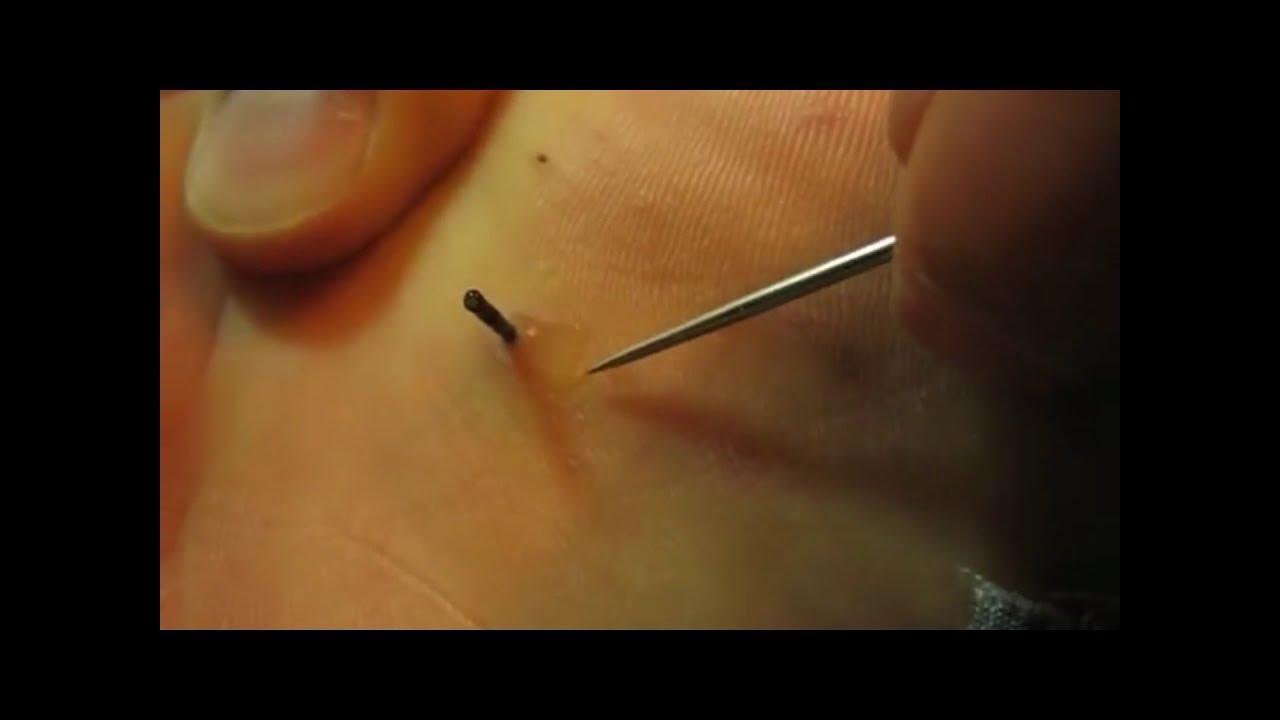 Splinter Removal Splinter in foot YouTube