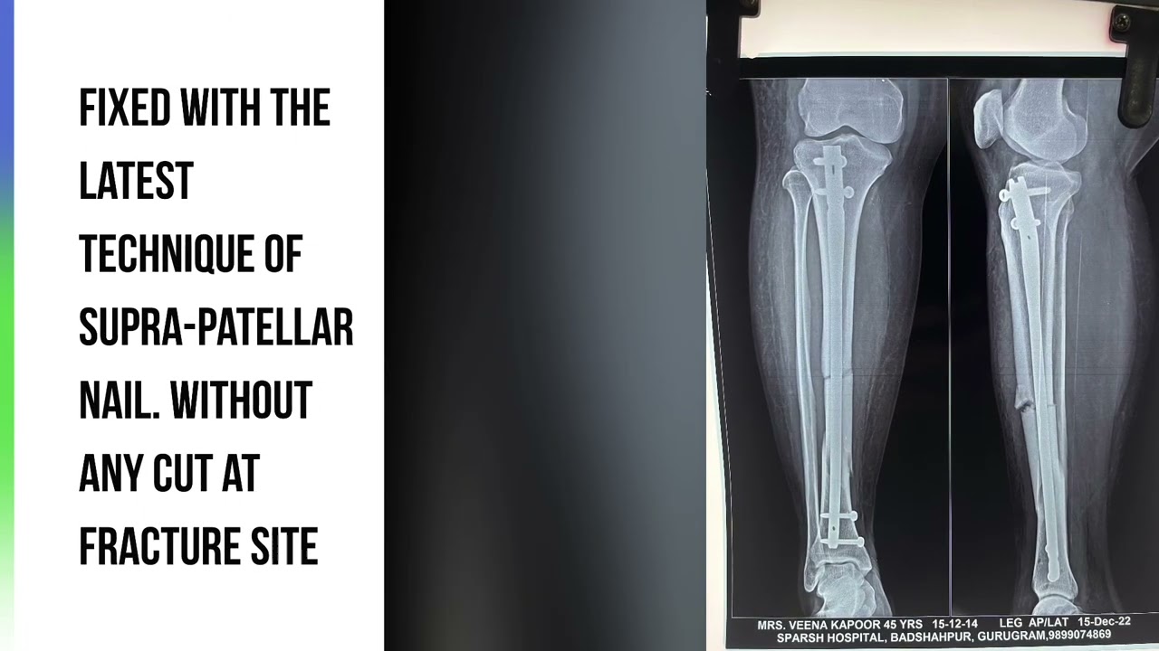 Controversies in the Intramedullary Nailing of Proximal and Distal Tibia  Fractures