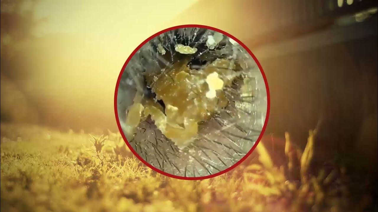 Satisfying Ear Wax Removal With Dr Zhao Video P232 YouTube