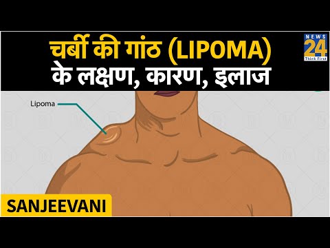 Sanjeevani: चर्बी की गांठ (Lipoma) के लक्षण, कारण, इलाज