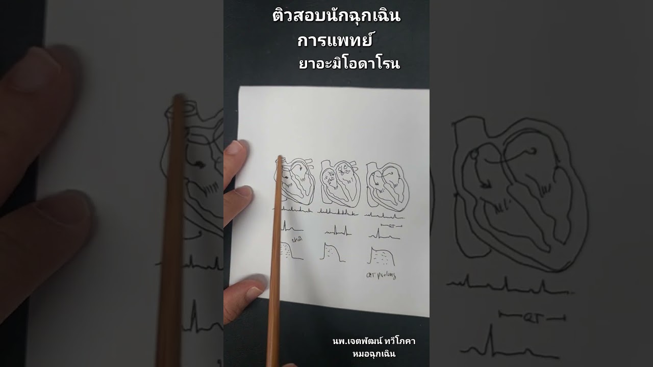 ติวสอบพาราเมดิก ยาฉุกเฉิน อะมิโอดาโรน (amiodarone) เหตุใดถึงใช้ และข้อควรระวัง