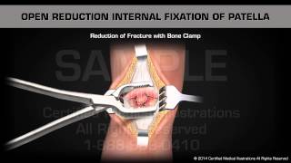 Open Reduction Internal Fixation of Patella