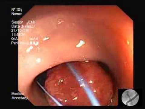 Polipectomia di Polipo del Colon con Endoloop - Endoscopic polypectomy with the use of endoloop