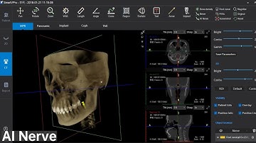 Dental photography Cone Beam CT software Single function display -- LargeV SmartVPro: AI+Nerve