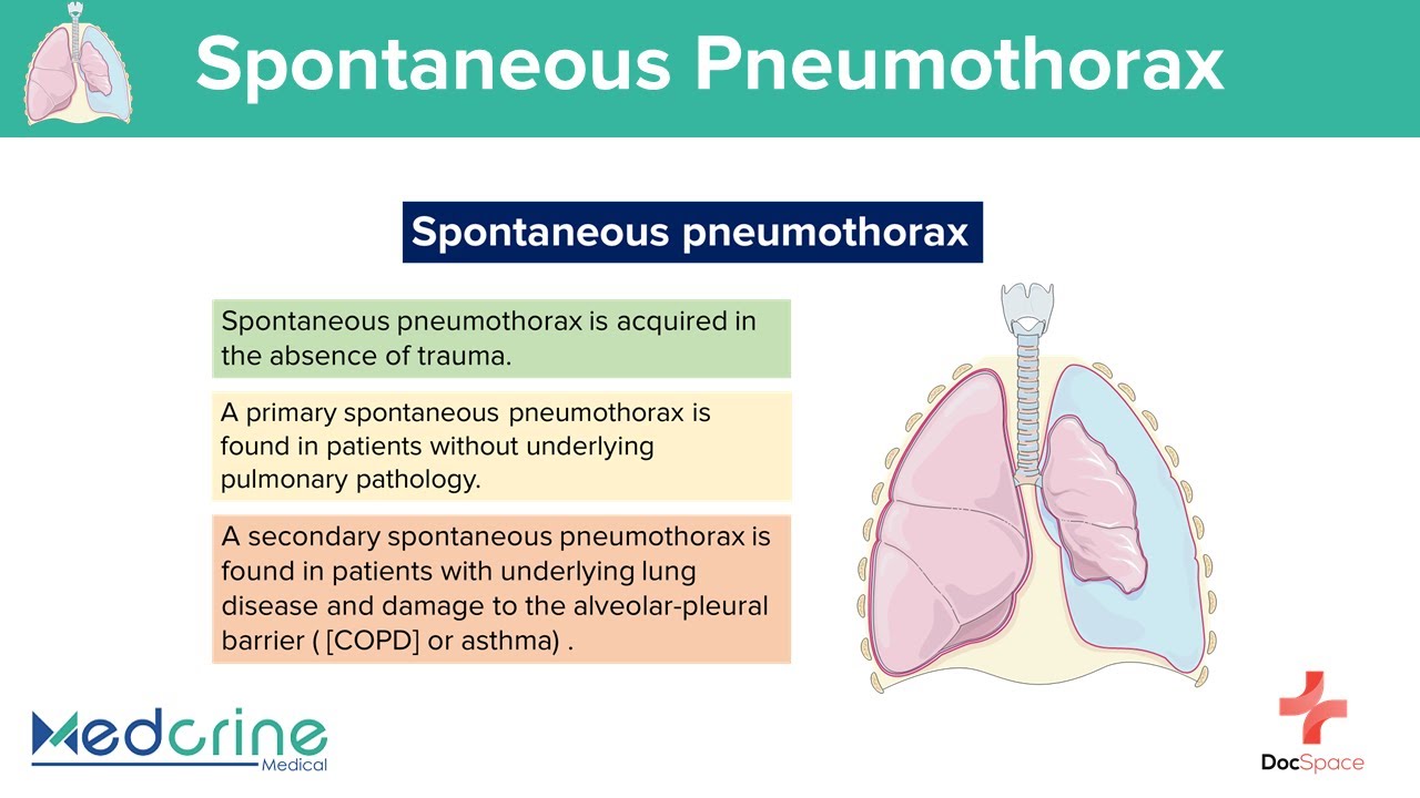 Primary Spontaneous Pneumothorax Pathogenesis And Clinical Findings ...