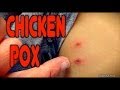 Chickenpox live diagnosis  dr paul