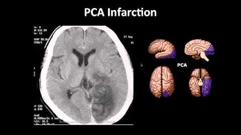 EMRADS: Stroke and its Imaging