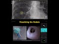 Direct Visualization Of The Lung Nodule Bronchoscopy Direct Visualization Of The Lung Nodule Bronchoscopy