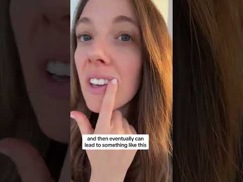 Treating Cracked Mouth