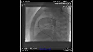 Baby Ayesha Rvf Puncture Technique 11 M 07 Kg Large Pda Device Done By Rvf Technique 8X6 Mm Cera Lat