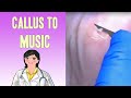 Callus Removal to Music - Music to Your Toes