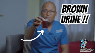 Dark Brown Urine - All you must know about brown urine color