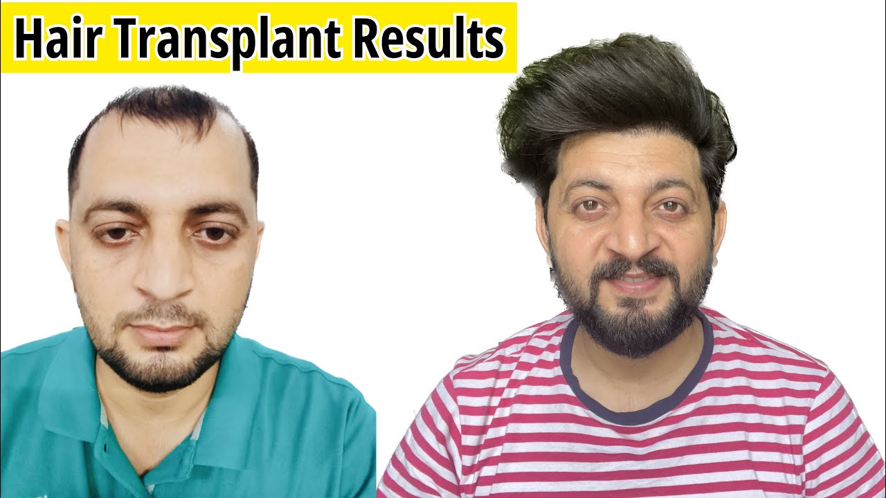 MY HAIR TRANSPLANT RESULTS AFTER 2 Year 5 Months | Best Hair Transplant ...