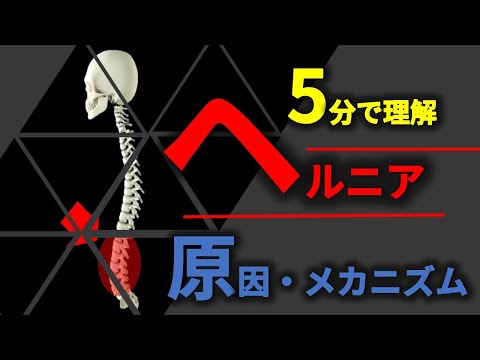 5分で理解できる椎間板ヘルニア原因とメカニズム【腰痛＃3】