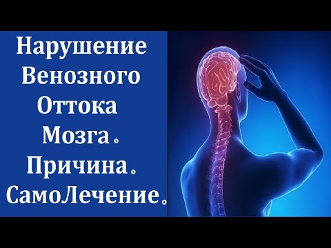 Венозный Отток Головного Мозга. Причина Нарушения. Лечение. Самолечение.