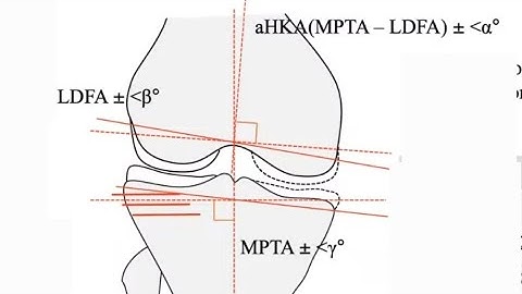 Personalised Alignment in Knee Replacement