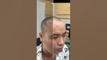 Những ai hói chữ m hãy làm cách này lập tức hết hói.Xăm tóc hói, xăm hói chữ m,