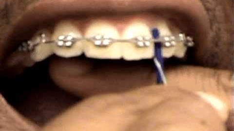 How to floss with braces - flossFish video demonstration