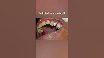 custom post and core #happy patient#