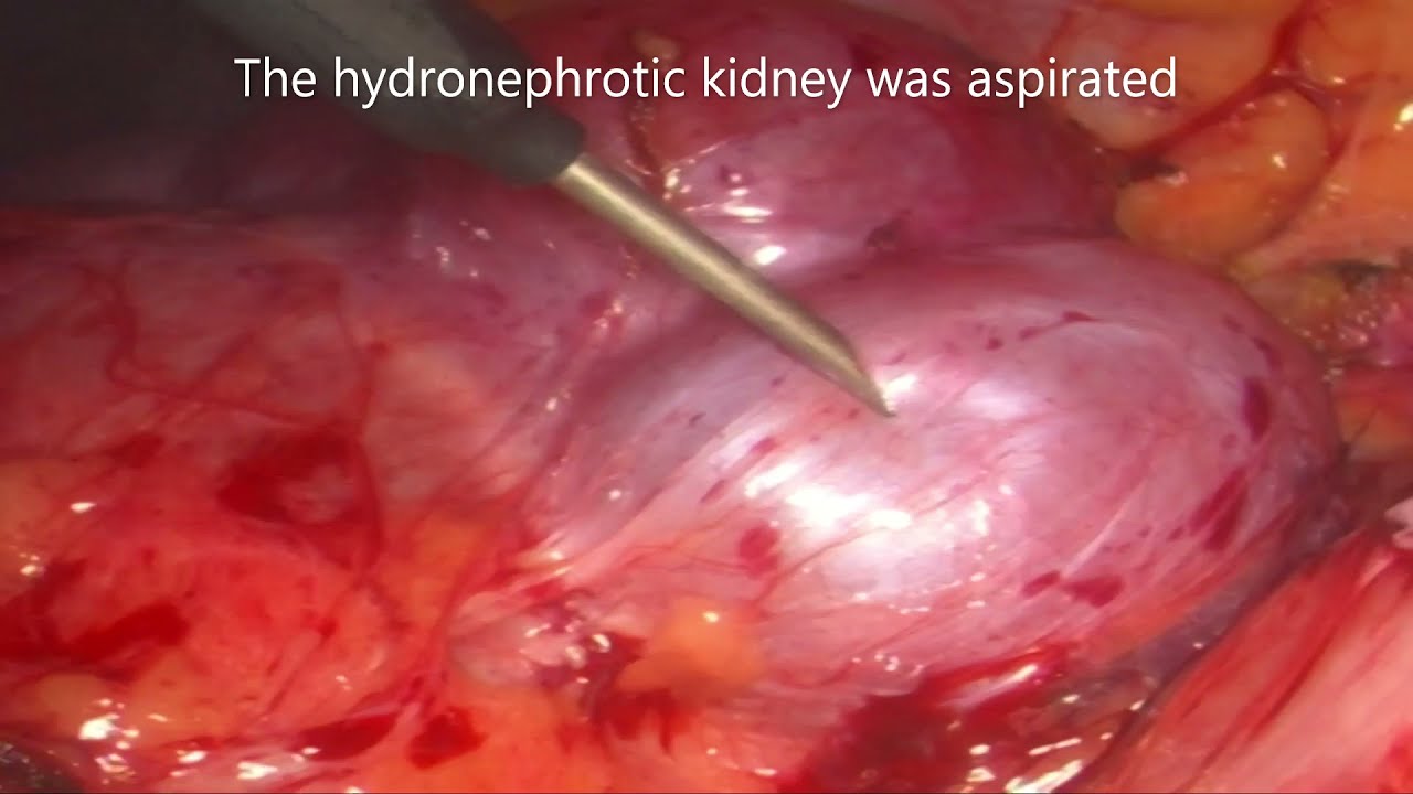 Lap nephrectomy for nonfunctioning UPJO by @Pediatric-Urologist