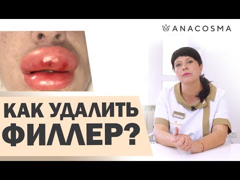 Как убрать филлеры в домашних условиях