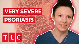 The Most Severe Case Of Psoriasis Dr Emma Has Ever Seen! | The Bad Skin Clinic