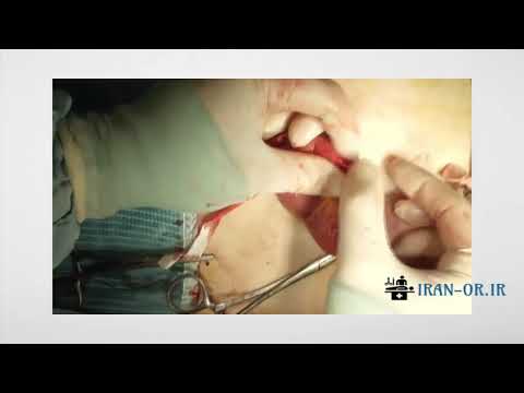 آموزش جراحی فتق ران (فمورال) با دوبله فارسی