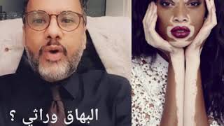 البهاق البهق البرص هل هوا معدي  دكتور علي باجنيد