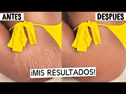 Vídeo: Estrías En El Trasero: Causas Y Cómo Deshacerse De Ellas