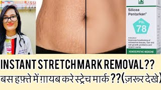 जल्दी स्ट्रेचमार्क ठीक कैसेकरे?Stretchmark removal instantly-Dr.rukmani homeopathy For Stria Removal