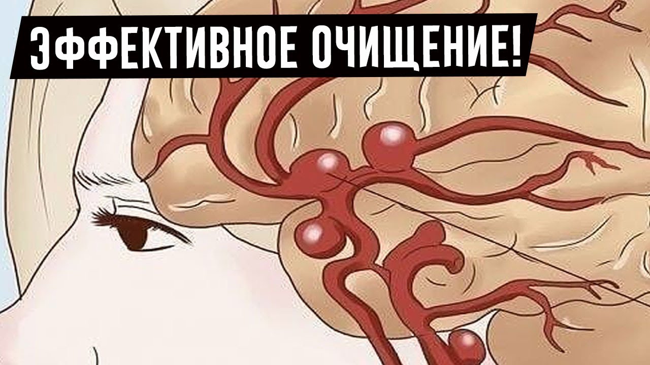 ПРИЗНАКИ "ЗАМУСОРИВАНИЯ" СОСУДОВ ГОЛОВНОГО МОЗГА! ЧТО ДЕЛАТЬ, ЕСЛИ ...