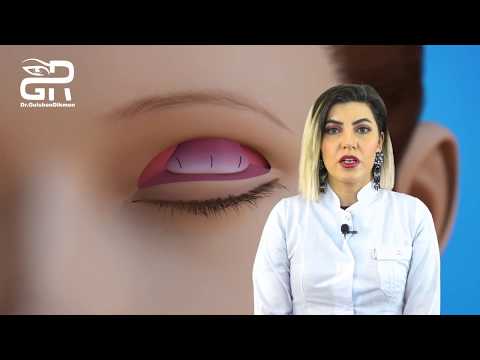 Video: Qaşıntılı göz qapaqlarını necə sakitləşdirmək olar: 11 addım (şəkillərlə birlikdə)