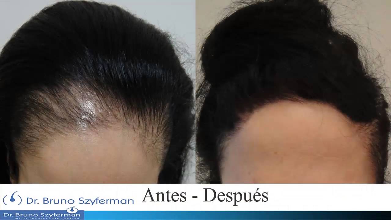 Implante de pelo venezuela Cortes de pelo con estilo 2018