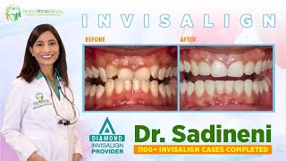 Before & After Of Invisalign Treatment. Complex Case Corrected By Dr.sadineni.