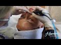 Hydrafacial with Dermaplaning: Your Best Glow Yet